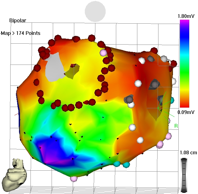 Adjunctive Surgical Atrial Fibrillation Ablation during Cardiac Surgery